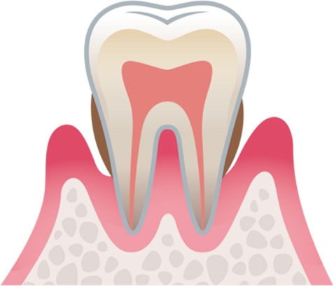 中度歯周病