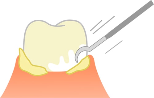 歯周疾患の改善